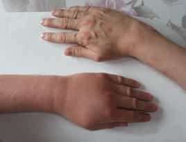 Danger de la piqûre de Guêpes